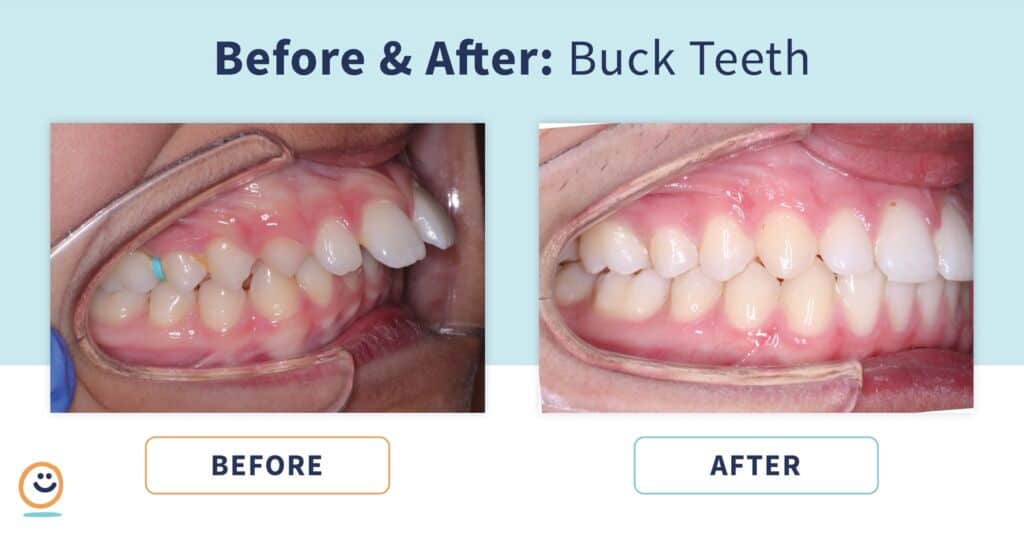 Braces Before And After Buck Teeth