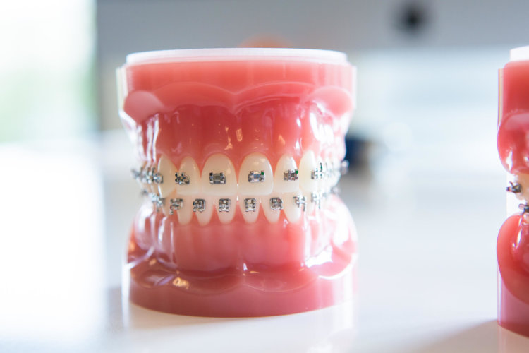Freeman-Orthodontics-Braces-Treatment-37-thegem-gallery-metro  - Braces and Invisalign in San Jose California - Freeman Orthodontics
