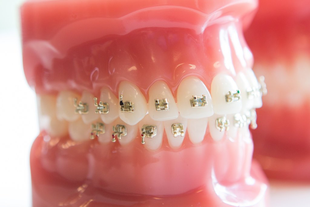 Freeman-Orthodontics-Braces-Treatment-45-1024x683  - Braces and Invisalign in San Jose California - Freeman Orthodontics