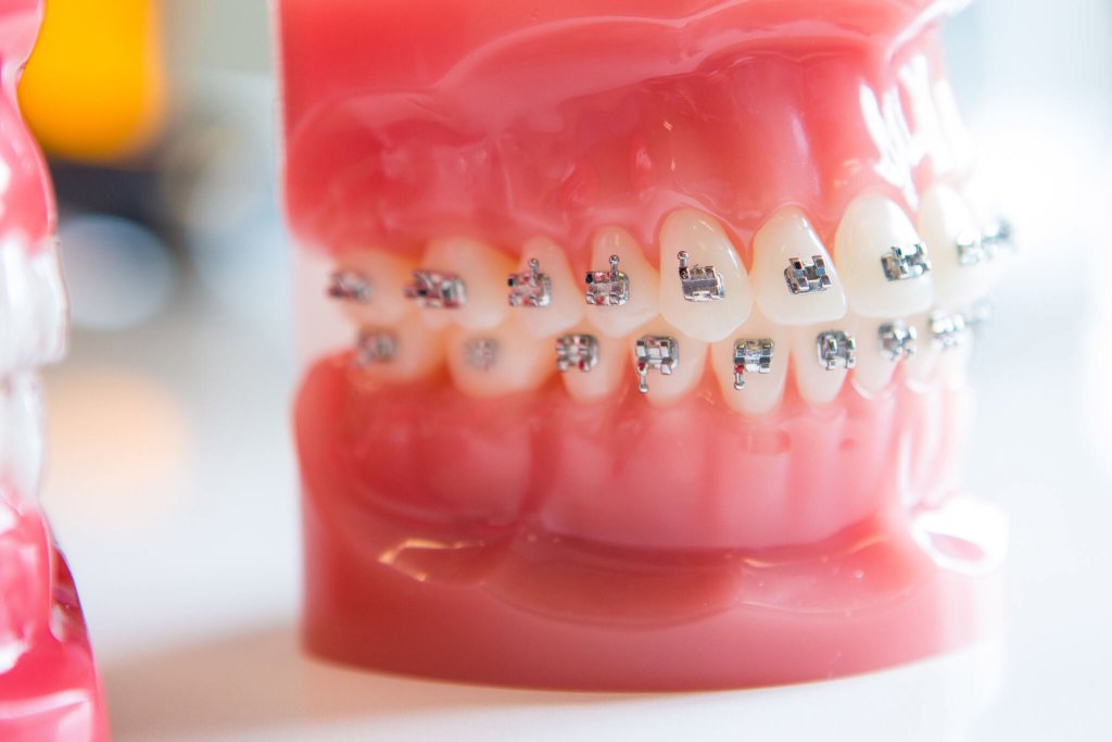 bracket-replace-1024x683  - Braces and Invisalign in San Jose California - Freeman Orthodontics