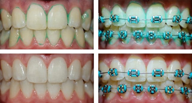 Teeth-thegem-blog-masonry  - Braces and Invisalign in San Jose California - Freeman Orthodontics