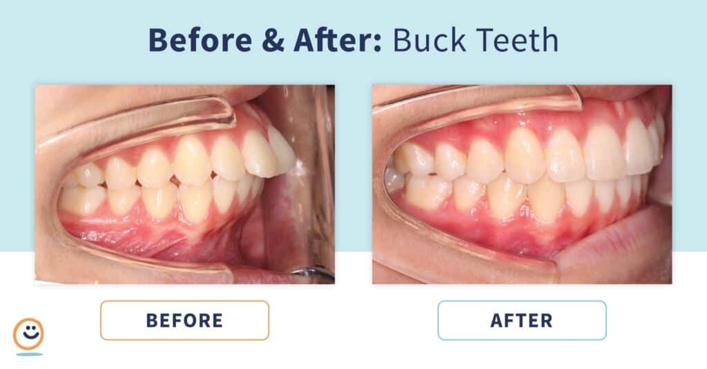 Braces Before and After Buck Teeth