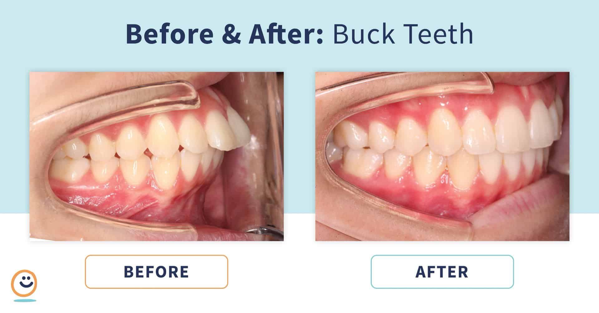 Astrolabe Ved naturpark Braces: Before and After Buck Teeth