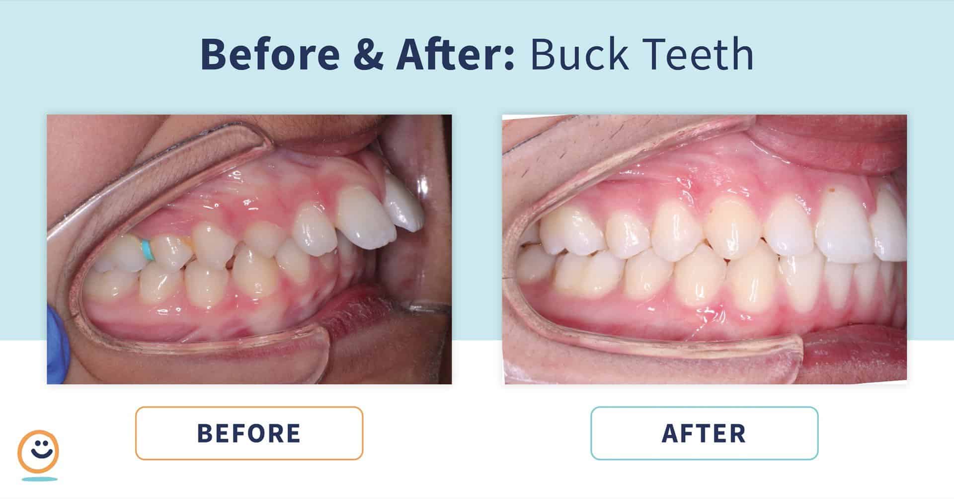 Astrolabe Ved naturpark Braces: Before and After Buck Teeth