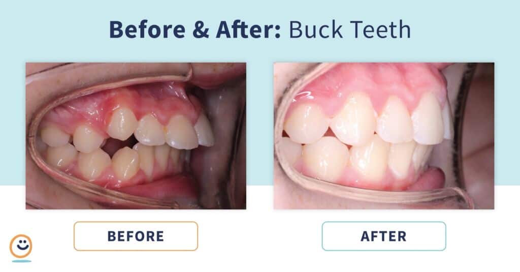 Braces Before And After Buck Teeth