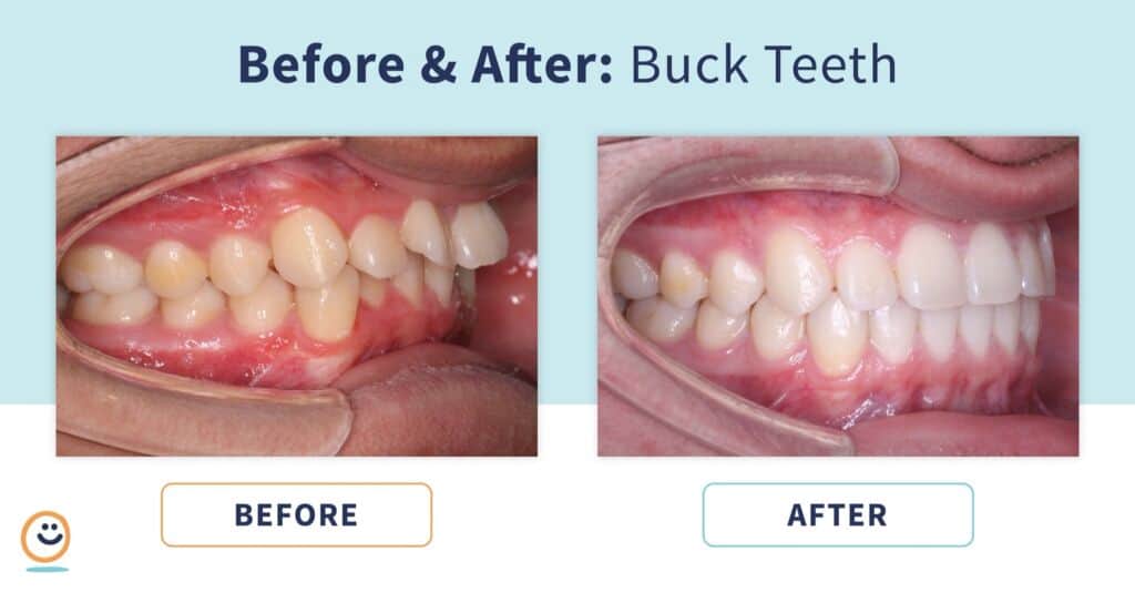 Braces Before and After Buck Teeth